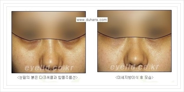 [두한성형외과 경쟁력 눈밑성형] - [눈밑 미세지방이식으로 다크써클 치료] 관련 이미지 13