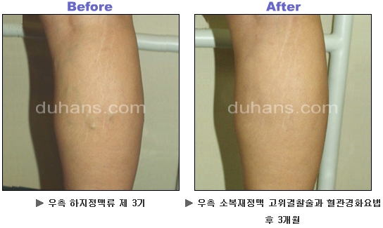 [두한성형외과 정맥류] - [하지정맥류, 정맥확장증, 혈관확장증] 관련 이미지 25