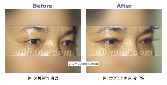 [두한성형외과 경쟁력 눈성형] - [상큼하고 환한 눈매! 상안검 성형(윗눈꺼풀 처짐) 안내] 관련 이미지 12