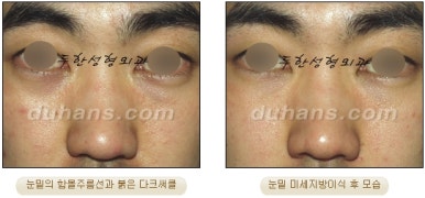 두한성형외과 눈밑성형 - 눈밑지방제거, 눈밑주름, 눈밑지방재배치 관련 이미지 69