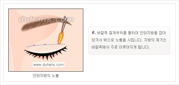 [두한성형외과 경쟁력 눈성형] - [퀵쌍꺼풀 안내] 관련 이미지 7