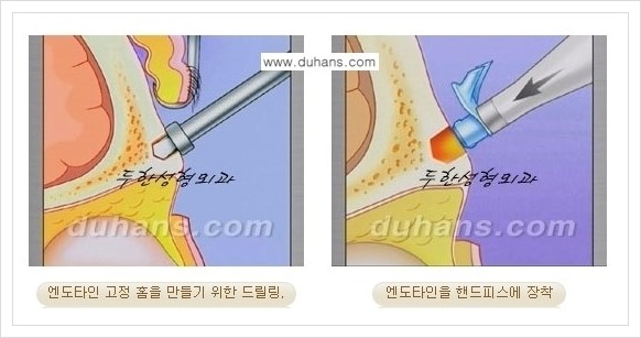 [두한성형외과 경쟁력 주름교정술] - [엔도타인 리프팅 안내 ③] 관련 이미지 4