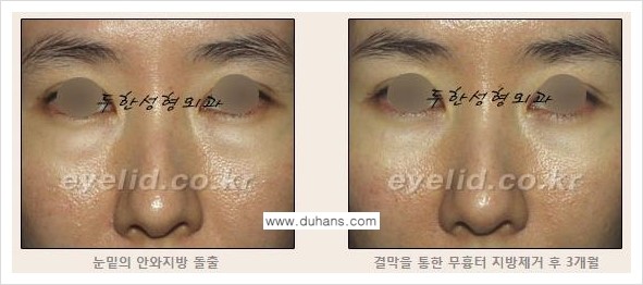 [두한성형외과 NO.1 눈성형] - [눈꺼풀 지방제거 관련 흔한 질문과 답변] 관련 이미지 2