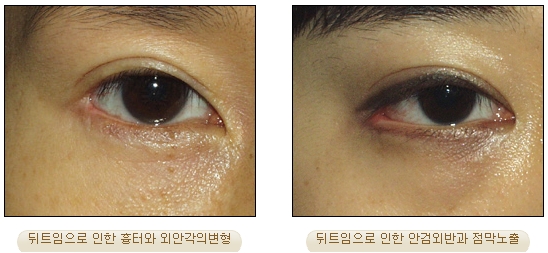 [Duhan Plastic Surgery Double Eyelid Revision] - [Inner Corner Revision, Outer Corner Revision] image 11