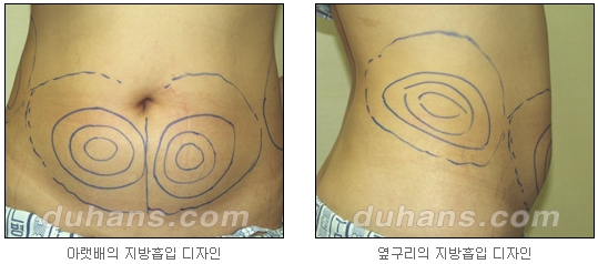[Duhan Plastic Surgery Simple Liposuction] - [Liposuction for Obesity] image 6