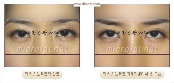 [두한성형외과 경쟁력 눈성형 리더] - [윗눈꺼풀 함몰( #꺼진눈꺼풀) 미세지방이식과 상안검성형]#꺼진눈성형 , #눈위함몰 관련 이미지 31