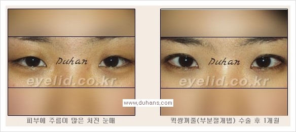 [두한성형외과 경쟁력 눈성형] - [퀵쌍꺼풀(부분절개법) 안내] 관련 이미지 11