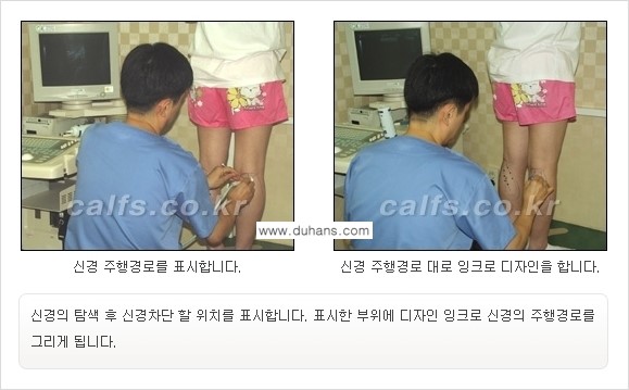 ​[두한성형외과와 날씬한 종아리 만들기!] - [간편하고 안전한 종아리 축소방법 ②] 관련 이미지 7