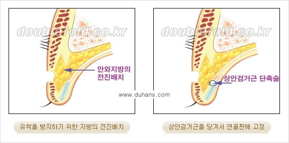 [두한성형외과 NO.1 "극한 눈(쌍꺼풀 재수술)"] - [안검하수(졸린눈매) 재수술 안내 2.] 관련 이미지 6