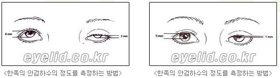 [Duhan Plastic Surgery Secondary Double Eyelid Surgery] - [Sleepy Eye Appearance, Asymmetrical Eye Appearance, Ptosis] image 6