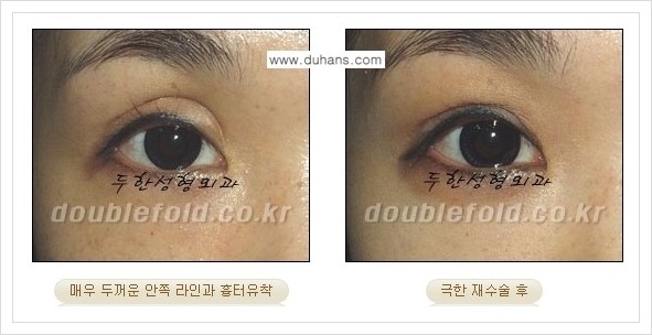 [두한성형외과 경쟁력 쌍꺼풀 재수술] - [극한의 상태에서 쌍꺼풀 재수술 안내 ①] 관련 이미지 11