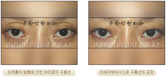 [Eye Reoperation Duhan Plastic Surgery] - [Guide to Double Eyelid Revision Surgery] image 69