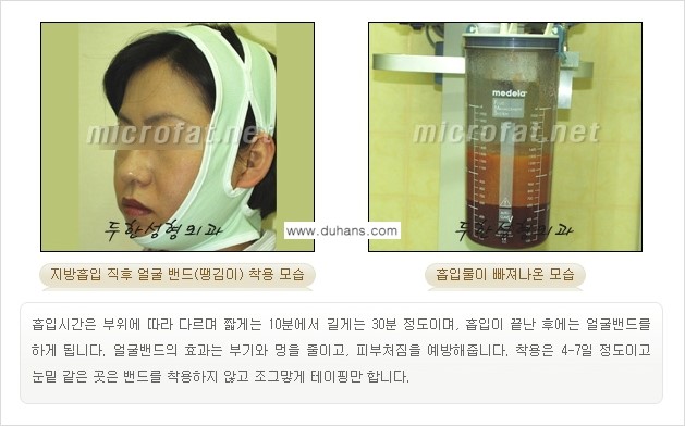 [두한성형외과 경쟁력 미세지방이식] - [타병원의 지방이식 부작용 교정을 위한 마이크로 흡입술 안내] 관련 이미지 7