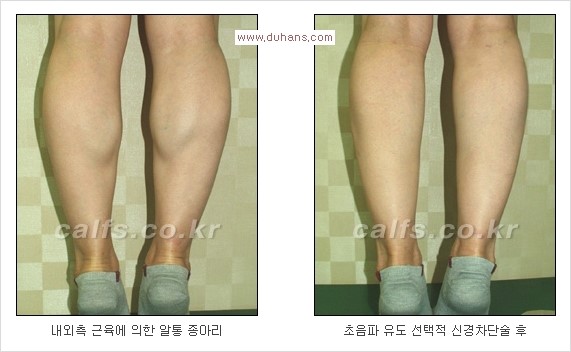 [두한성형외과 Dr. 컬럼] - [종아리 근육퇴축술로 가장 선호하는 비절개 초음파 유도 선택적 신경차단술] 관련 이미지 20