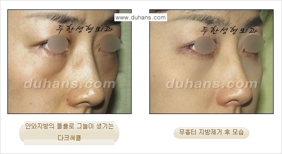 [두한성형외과 젊은 눈매 안검성형] - [눈밑 지방제거의 수술 전후 안내 ②] 관련 이미지 9