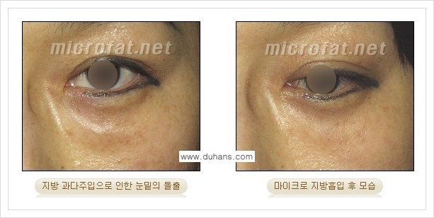 [두한성형외과 경쟁력 지방이식] - [지방이식 부작용 - 지방이식 후 지방이식 과다주입, 과다생착의 교정 안내] 관련 이미지 5