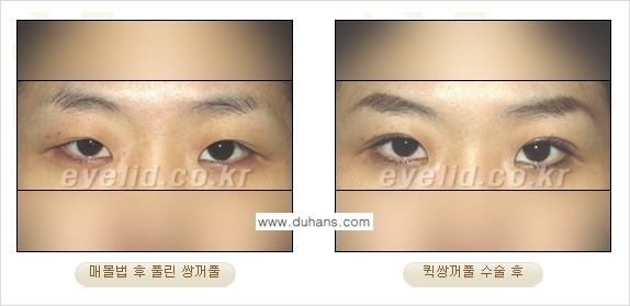 [두한성형외과 성형 FOCUS] - [퀵쌍꺼풀 수술 ④] 관련 이미지 5
