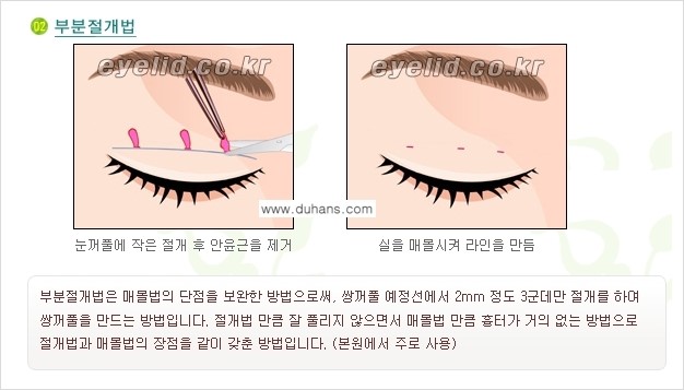 [두한성형외과 성형 FOCUS] - [퀵쌍꺼풀 수술 ①] 관련 이미지 6