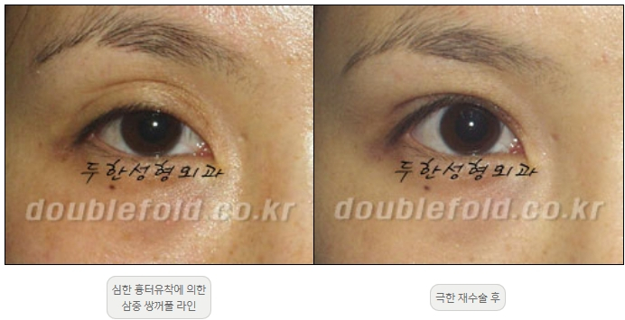 [Double Eyelid Surgery, Duhan Plastic Surgery] - [Extreme Revision Eye Surgery to Correct a Damaged Line] image 8
