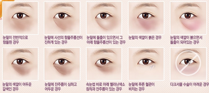 두한성형외과 눈밑 다크서클 5STEP 솔루션 관련 이미지 2