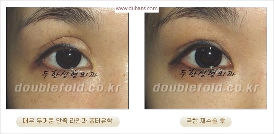 [두한성형외과 경쟁력 눈성형] - [극한 재수술, 함몰된 눈꺼풀 라인교정, 안검하수(졸리운 눈매)] 관련 이미지 12