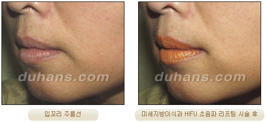 두한성형외과 주름개선 - 주름 HIFU 리프팅 관련 이미지 32