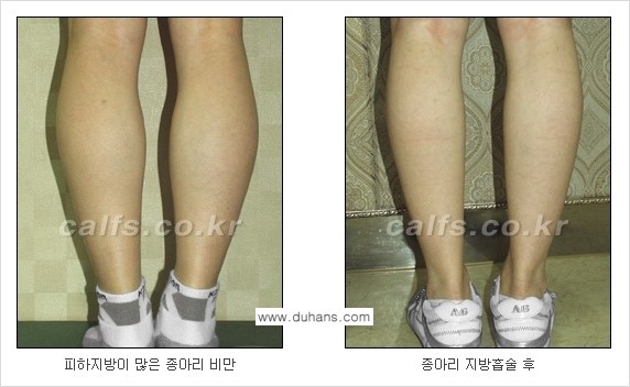 [두한성형외과 경쟁력 멀티종아리성형] - [종아리(다리) 비만 해결 방법 안내] 관련 이미지 8