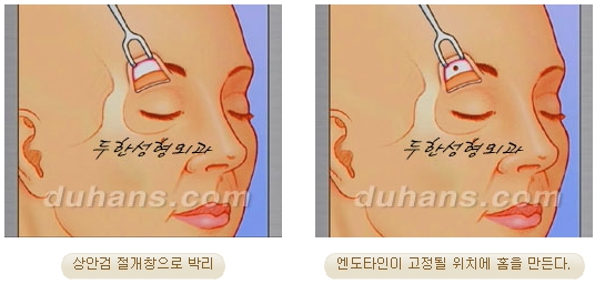 두한성형외과 안티에이징 리프팅 - 엔도타인 리프팅 관련 이미지 33