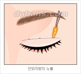 [두한성형외과 경쟁력 눈성형 리더] - [아름다운 눈매를 위한 쌍꺼풀 수술 안내] 관련 이미지 7