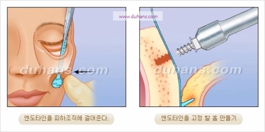 [두한성형외과 주름성형] - [주름교정술 - 강력한 리프팅 파워 엔도타인 리프팅 ] 관련 이미지 35