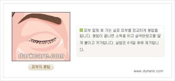 [두한성형외과 경쟁력 다크써클 치료] - [하안검 성형과 눈밑지방 재배치 안내] 관련 이미지 8