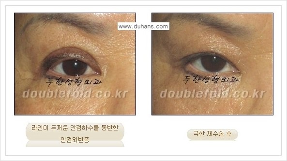 [두한성형외과 경쟁력 쌍꺼풀 재수술] - [극한의 상태에서 쌍꺼풀 재수술 안내 ①] 관련 이미지 10