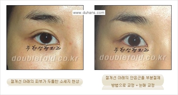 [두한성형외과 경쟁력 극한눈(쌍꺼풀)재수술] - [절개선 아래가 두툼한 소세지 쌍꺼풀 교정] 관련 이미지 5