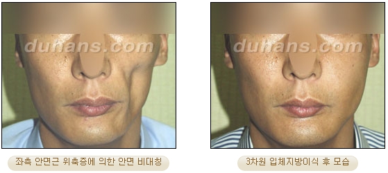 [두한성형외과 얼굴자가지방이식] - [볼살, 이마, 측두부] 관련 이미지 30