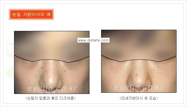 [두한성형외과 경쟁력 눈밑성형] - [다크써클 수술 안내 2.] 관련 이미지 6