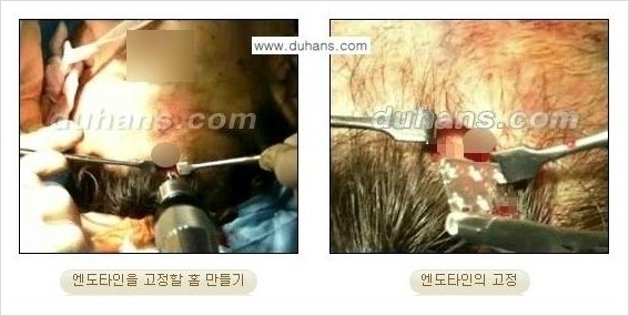 [두한성형외과 경쟁력 동안성형 리더] - ​[미간주름, 이마주름, 안검성형, 이마거상술, 눈썹거상술] 관련 이미지 50