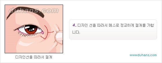 [두한성형외과 경쟁력 눈성형] - [몽고주름 제거수술, 앞트임 수술 안내] 관련 이미지 10