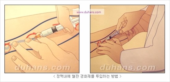 [두한성형외과 경쟁력 정맥류 치료] - [정맥류 치료의 모든 것] 관련 이미지 9