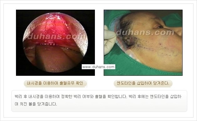 [두한성형외과 경쟁력 주름성형] - [주름제거 방법 안내] 관련 이미지 10