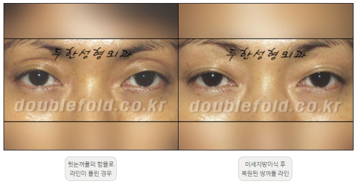[두한성형외과 쌍커풀재수술] - [풀린 쌍커풀라인 교정] 관련 이미지 14