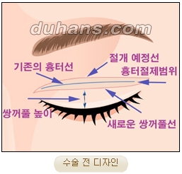 눈성형잘하는곳 두한성형외과 - 겹쌍꺼풀 관련 이미지 15
