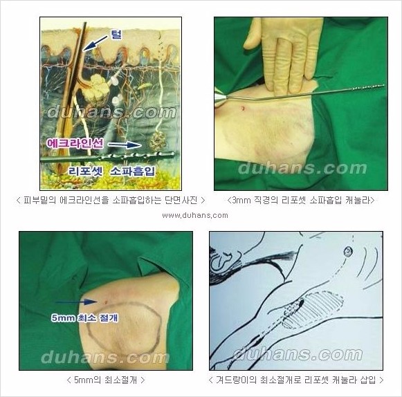 ​[두한성형외과 경쟁력 다한증 치료] - [참기 힘든 땀의 해결! 겨드랑이 다한증의 리포셋 소파흡입술] 관련 이미지 2