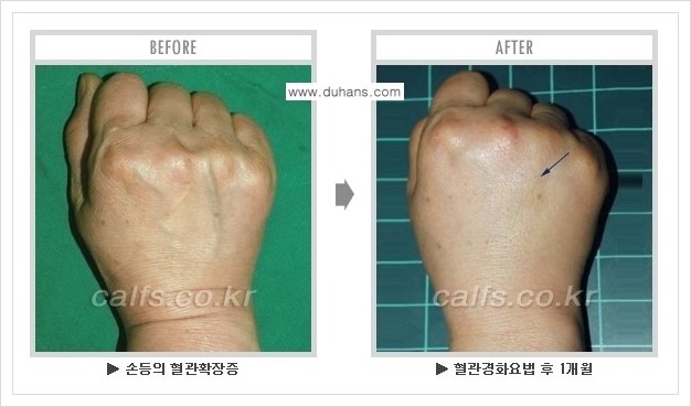 [두한성형외과 정맥류 치료] - [손, 팔 정맥확장증 사진자료 안내 ①] 관련 이미지 2