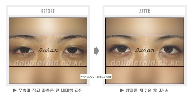 [두한성형외과 Dr. 컬럼] - [쌍꺼풀 재수술(눈 재수술)의 목적] 관련 이미지 7