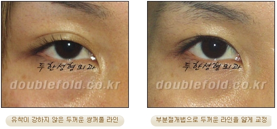 [두한성형외과 쌍커풀수술] - [눈성형 방법에 대한 자주하는 질문과 답변] 관련 이미지 12
