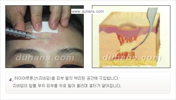 [두한성형외과 함몰 흉터 교정] - [동시에 3가지 시술로 효과적인 흉터의 교정 안내 ①] 관련 이미지 8