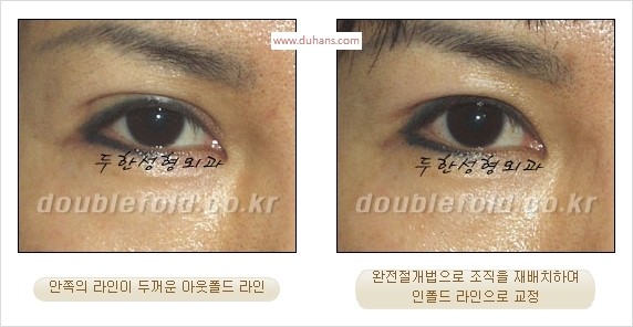 [두한성형외과 경쟁력 눈성형] - [완전절개법(Full incision method)의 재수술 과정] 관련 이미지 11