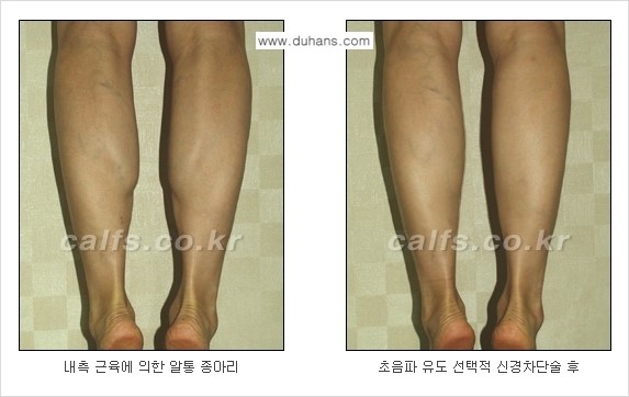 ​[두한성형외과와 날씬한 종아리 만들기!] - [간편하고 안전한 종아리 축소방법 ④] 관련 이미지 2