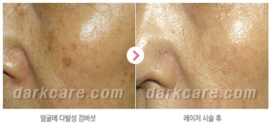 [눈밑수술 두한성형외과] - [다크서클 콤비프로그램] 관련 이미지 165