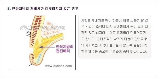 ​​[두한성형외과 경쟁력 쌍꺼풀(눈) 재수술] - [쌍꺼풀(눈) 재수술 실패의 원인 분석 안내] 관련 이미지 5
